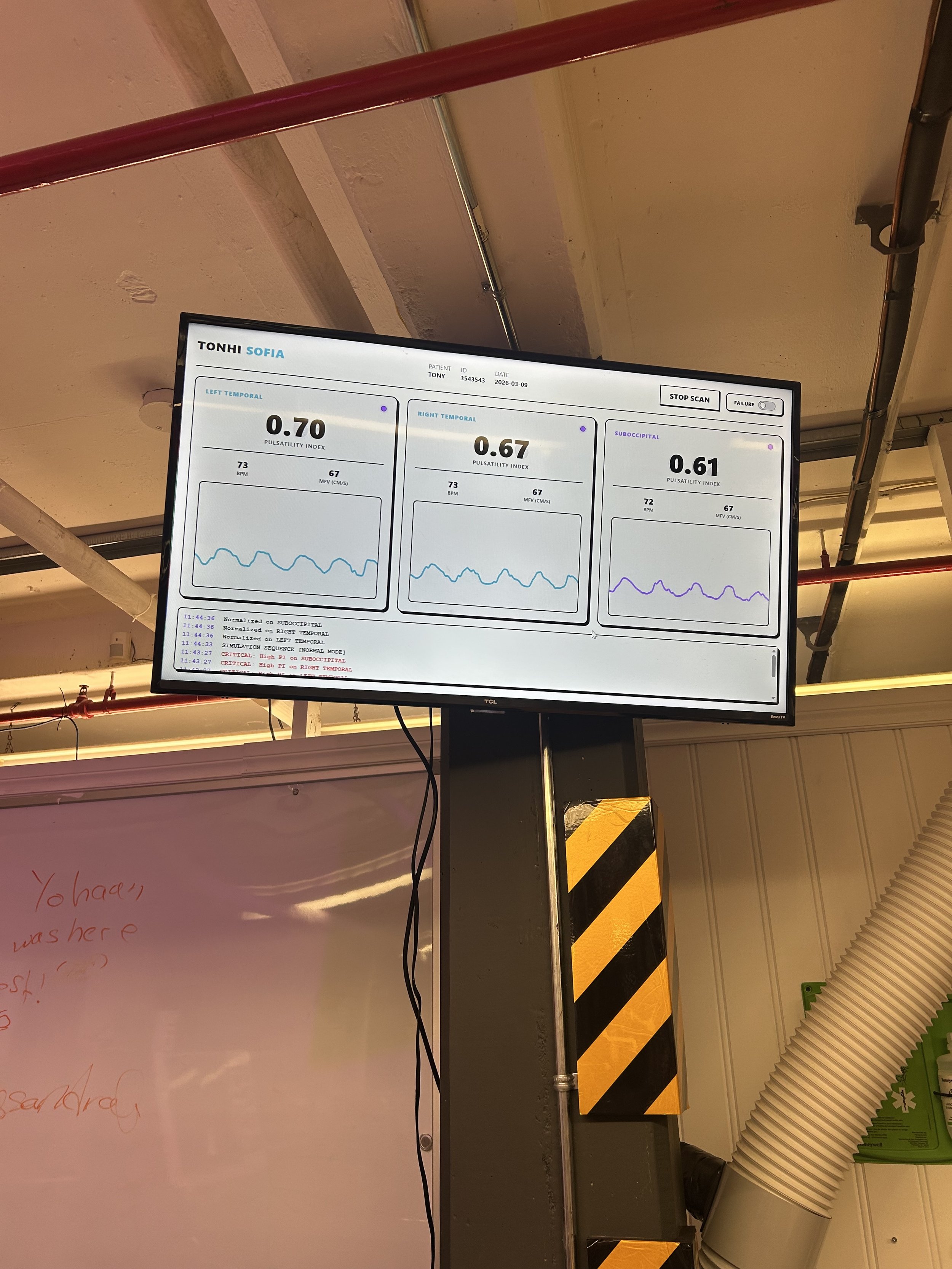 Monitor displaying brainwave data with three sections labeled Left Temporal, Right Temporal, and Suboccipital, each showing pulsatility index scores and line graphs, mounted on a pole in a clinical or laboratory setting.