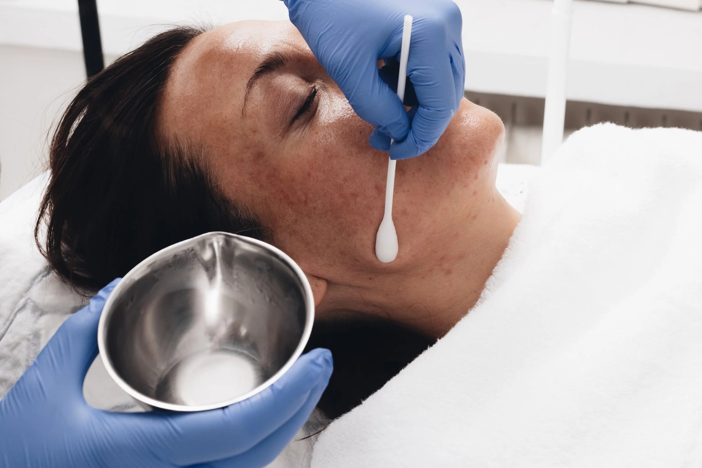 Ihon pinnoitushoito ja kemiallinen kuorinta Turussa