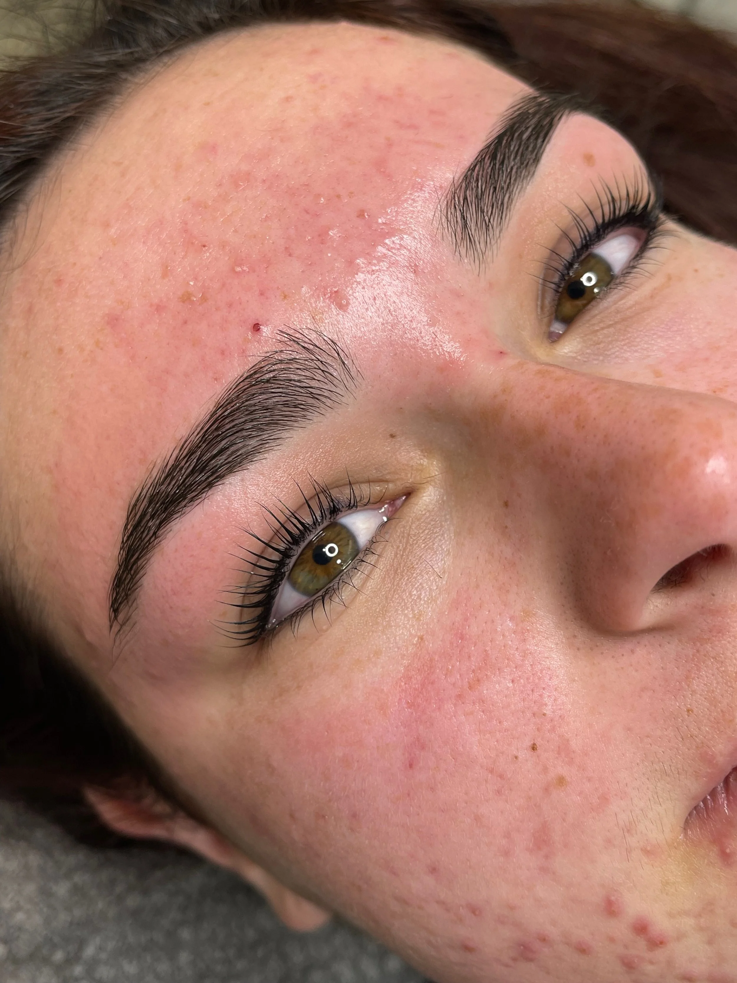 Close-up of a person's face showing skin with acne, redness, and some pimples.