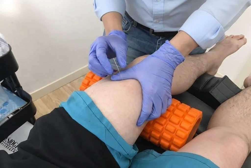 Dry needling therapy for knee pain performed by Ivan Lam Physio in Melbourne, specifically in Blackburn North, Boronia and Chadstone.