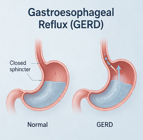 Diagram showing the difference between normal and GERD conditions in the esophagus. The normal diagram depicts a closed sphincter preventing stomach acid from refluxing, while the GERD diagram shows an open sphincter allowing acid to flow back into the esophagus.