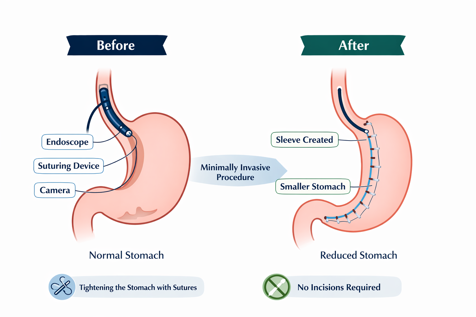 Comparison of stomachs before and after minimally invasive procedure. The 'before' side shows a normal stomach with labels for endoscope, suturing device, and camera; the 'after' side shows a reduced stomach with sleeve created and smaller stomach, indicating no incisions needed.