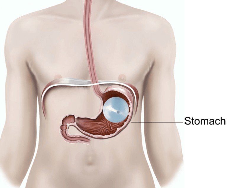 Illustration of a human stomach inside the body, showing the stomach labeled and connected to the esophagus and small intestine.
