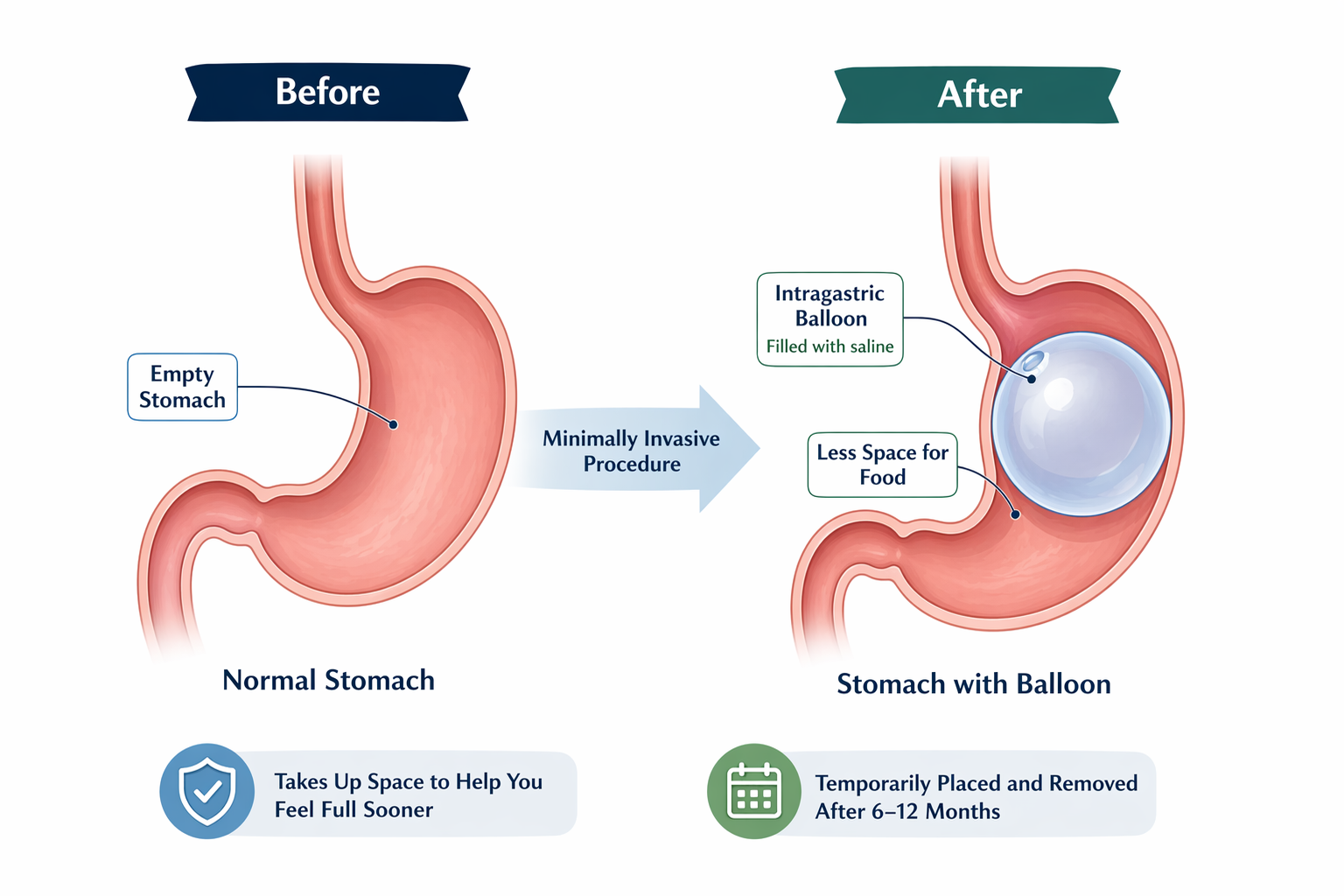 Diagram showing a minimally invasive gastric balloon procedure. The left side labeled 'Before' depicts an empty stomach, while the right side labeled 'After' shows a stomach with a filled saline balloon, reducing space for food. The bottom notes that the procedure helps feel full sooner and the balloon is temporary, removed after 6-12 months.