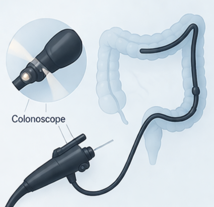 A medical illustration showing a colonoscope inserted into the colon for a colonoscopy procedure.