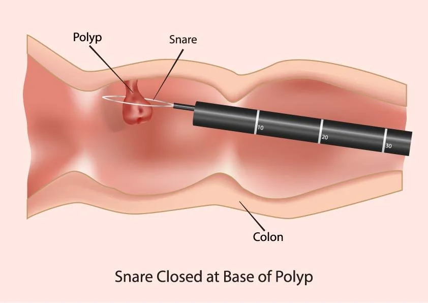 Medical illustration showing an endoscopic procedure for removing a polyp from the colon. The snare loop is closed around the base of the polyp and there is a snare wire within the colon, with a label indicating the polyp, snare, and colon.