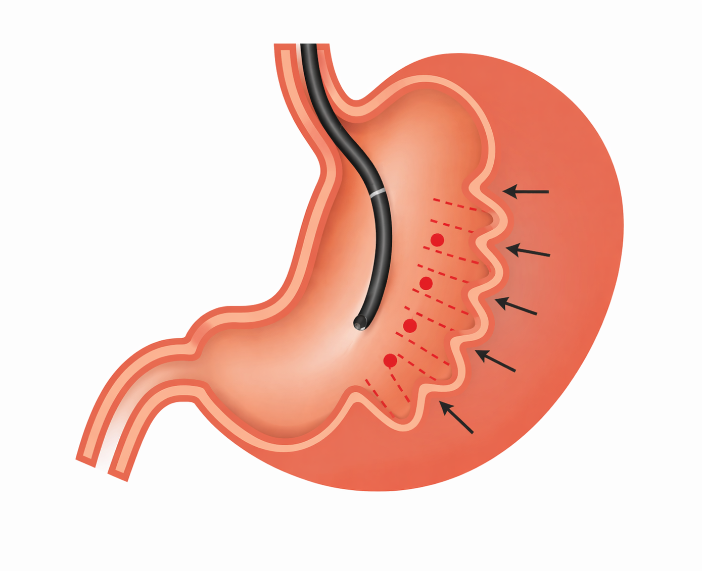 Diagram of a stomach with arrows pointing to its inner wall, illustrating a medical procedure involving a tube and targeted treatment areas inside the stomach.