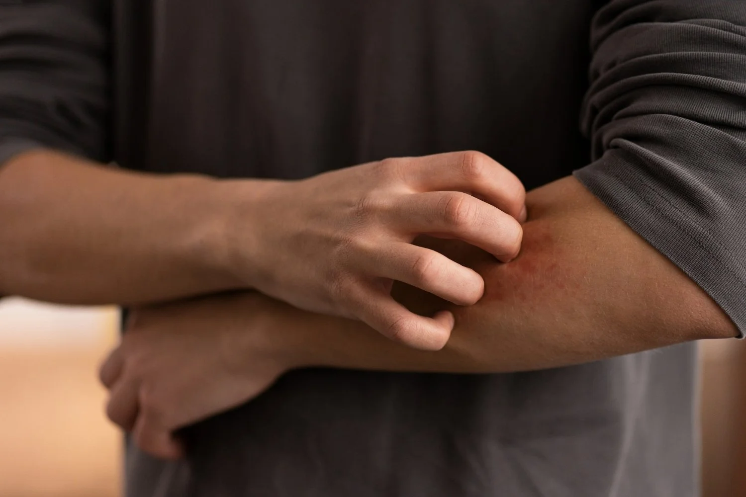 Person experiencing dry, irritated skin, illustrating one of the common effects homeowners associate with chlorine in Perth's drinking water.
