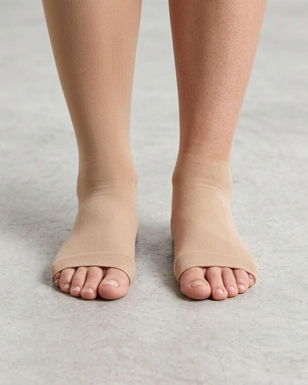 Medical compression stocking for lipoedema improving circulation and lymphatic drainage