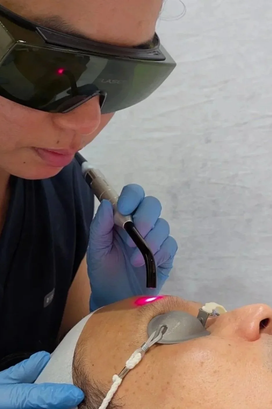 A person wearing sunglasses and blue gloves is performing a cosmetic or medical procedure on a patient's upper eyelid using a handheld device with a red laser. The patient is lying down with protective eye shields.