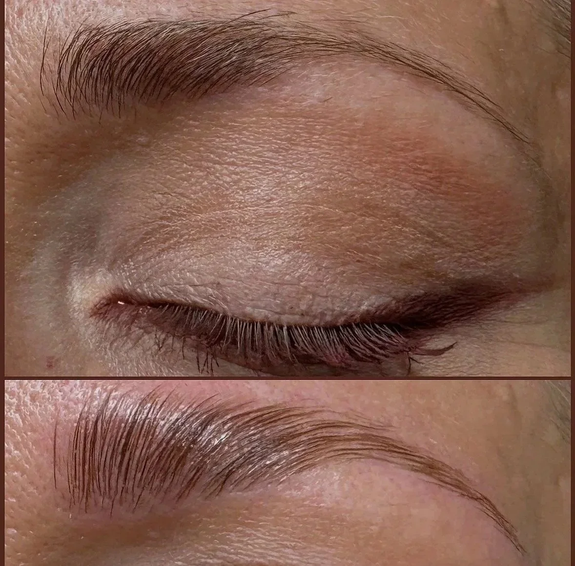 Brow Lift