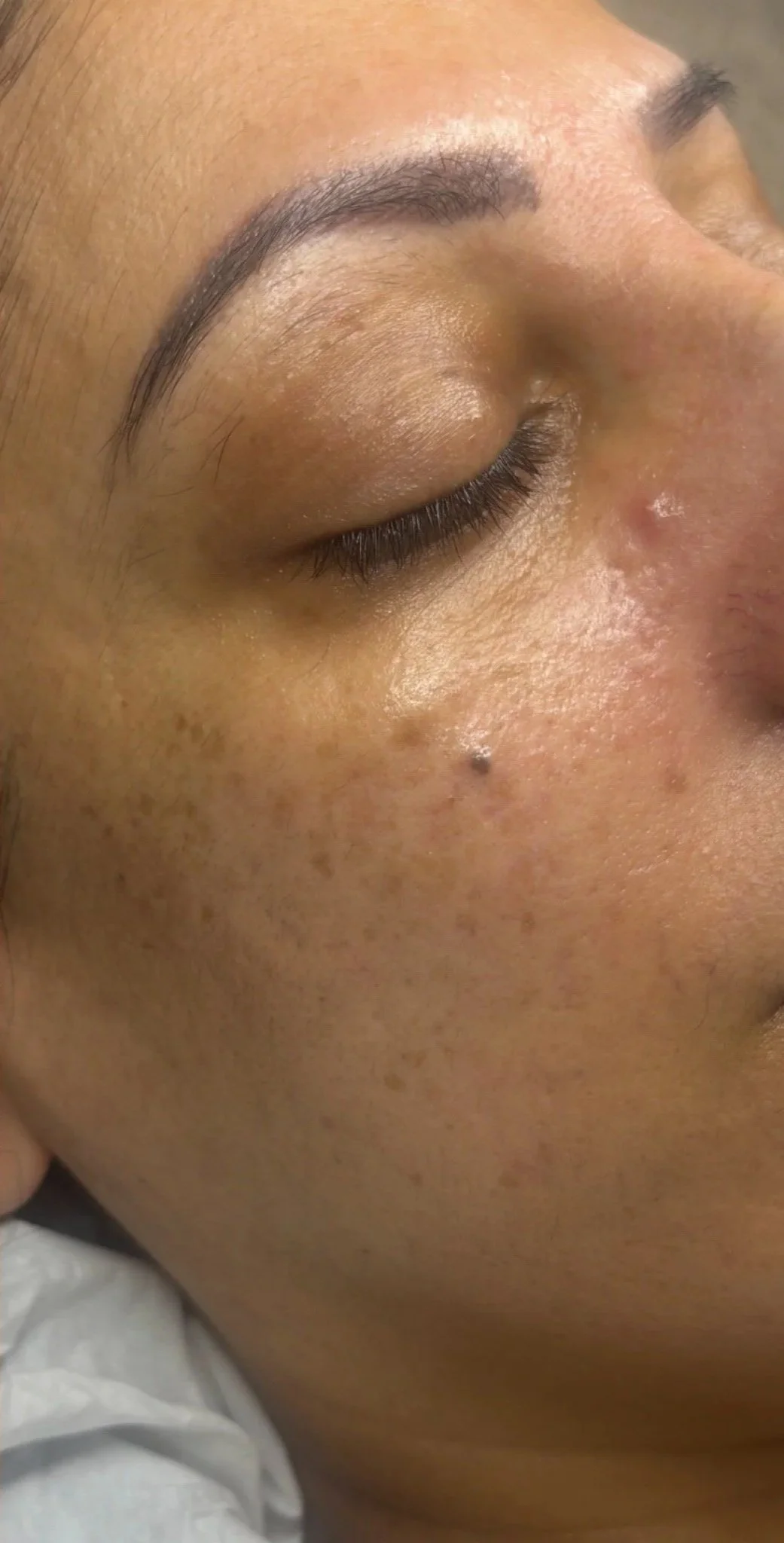 Close-up of a person's face with closed eye, visible eyebrow, and skin details including freckles and minor blemishes.