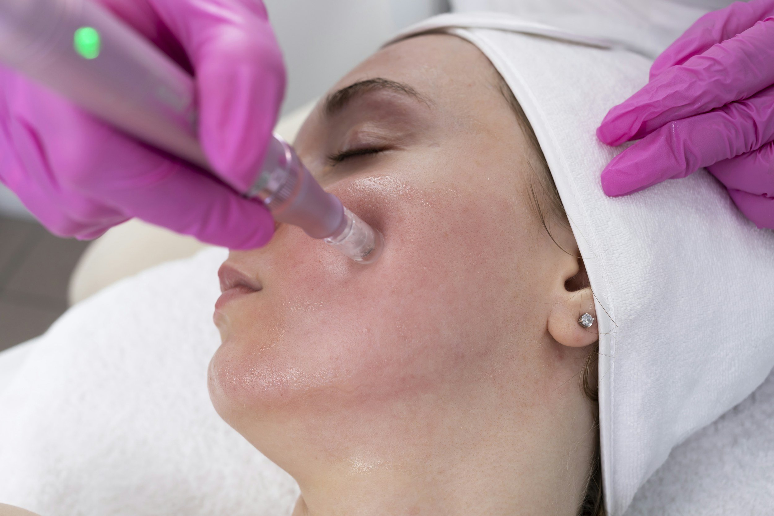 A woman lying down with her eyes closed, receiving a cosmetic treatment with a syringe, wearing a white head covering and pink gloves.