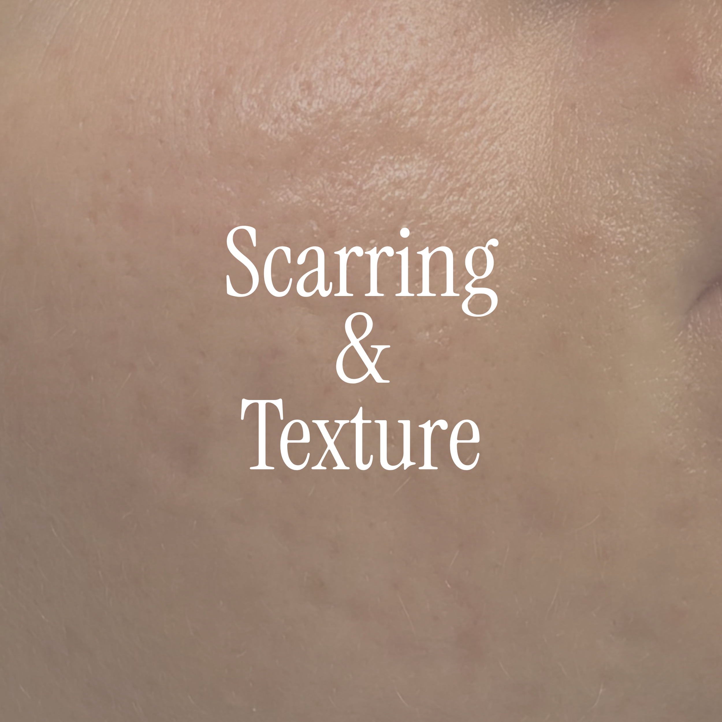 For acne scarring, uneven texture, enlarged pores and skin that feels rough or uneven.