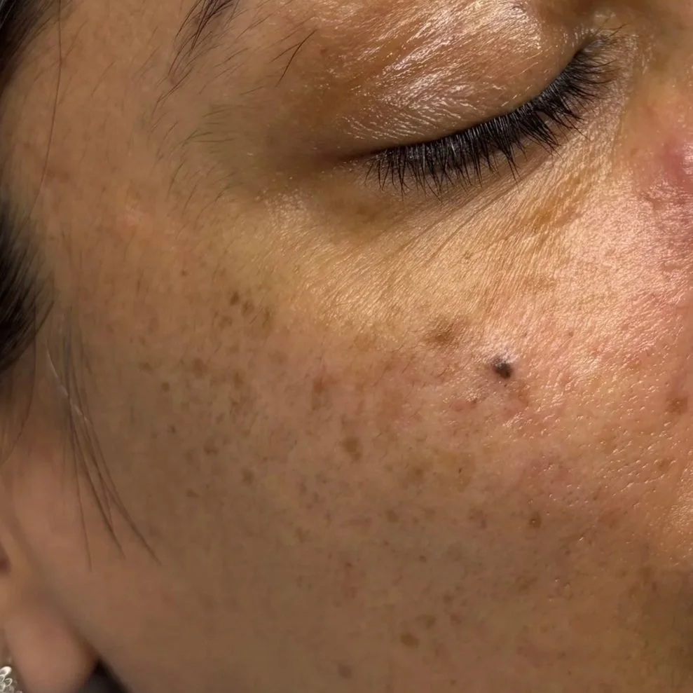 Close-up of a person's cheek with freckles and a mole, and part of their closed, dark eyelashes.