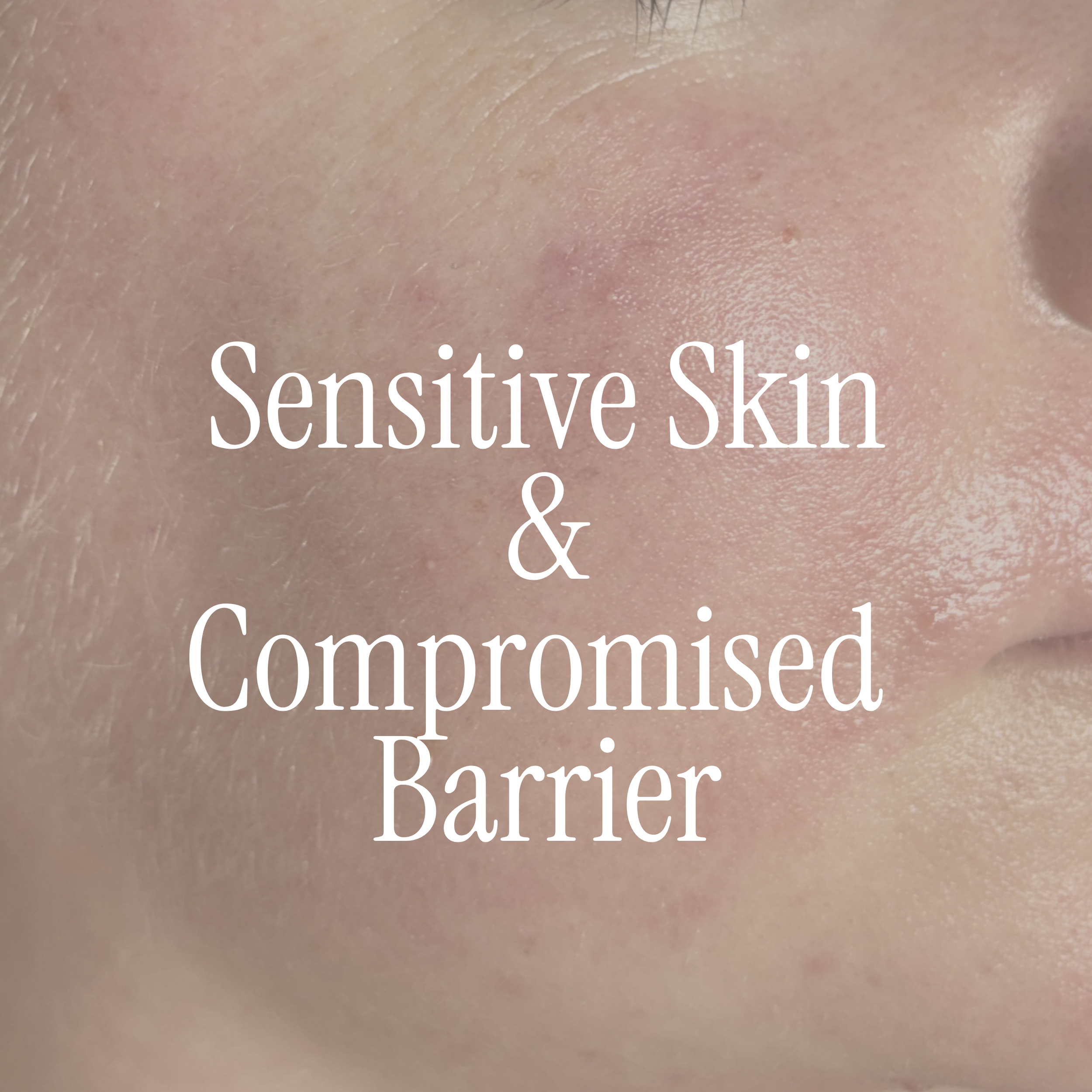 For dry, irritated, tight, reactive or compromised skin barriers.