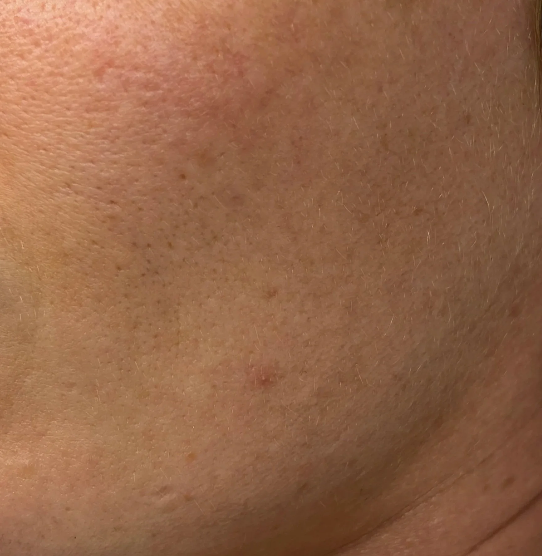 Close-up of human skin with visible hair follicles and some blemishes.
