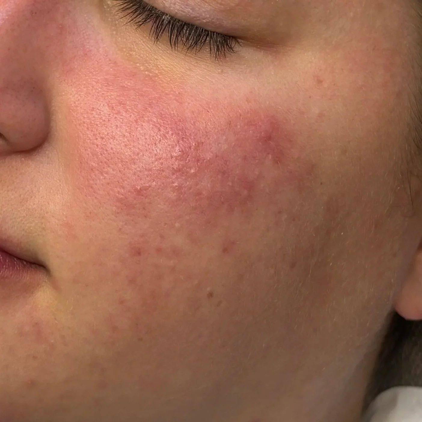 Close-up of a person's cheek showing redness, pimples, and acne scars.