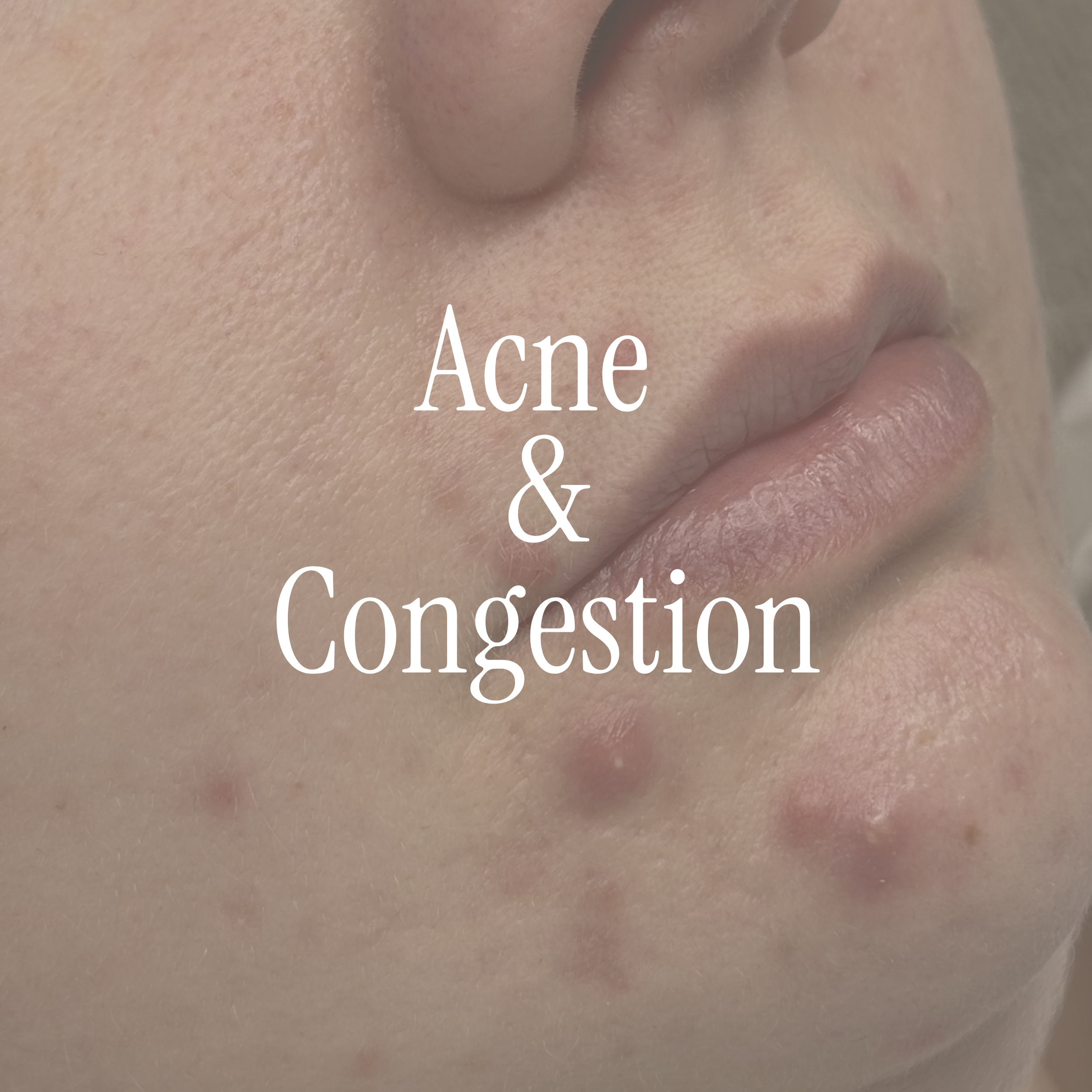 For breakouts, blocked pores, blackheads, hormonal blemishes and post-breakout marks.