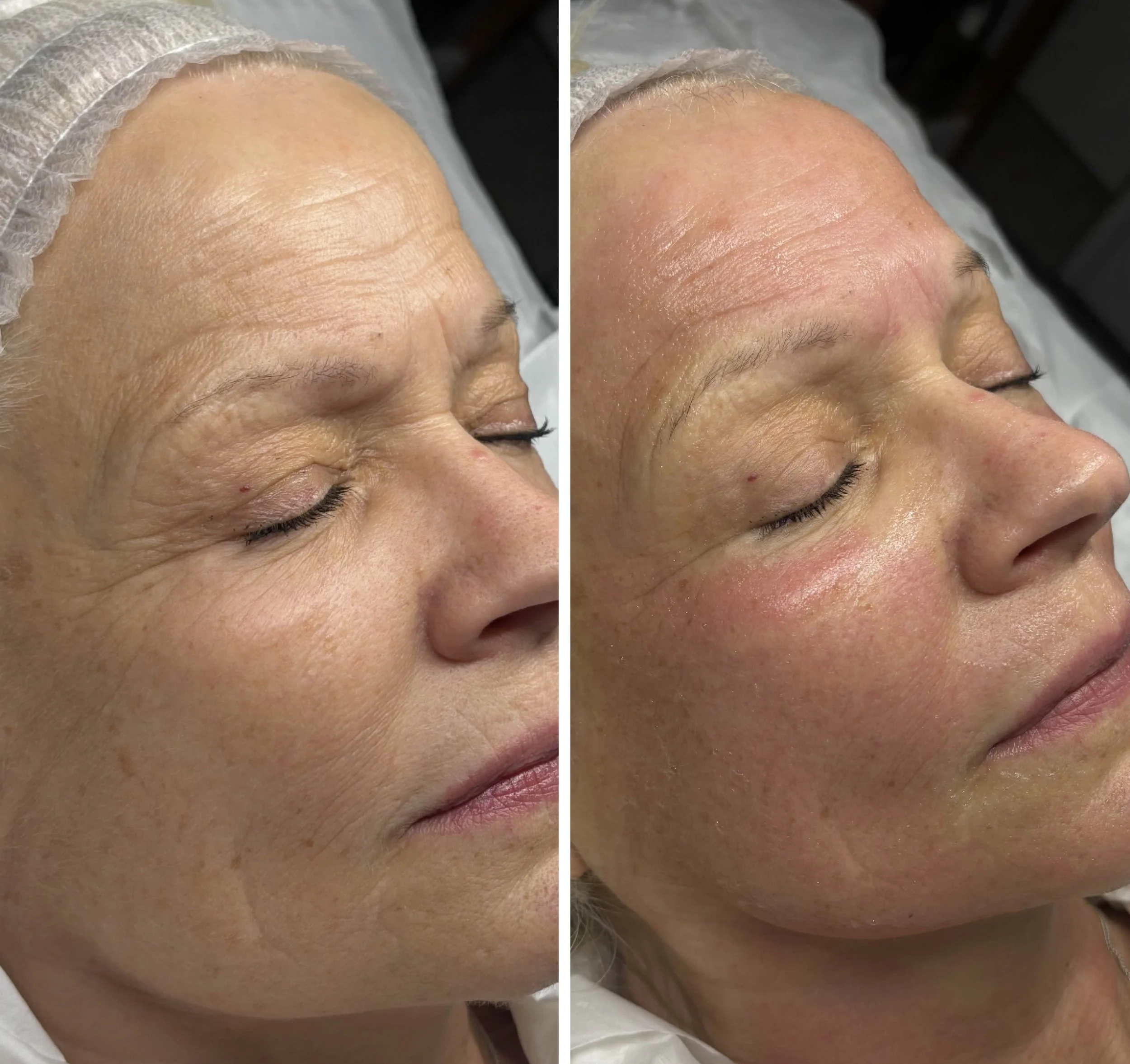 A close-up of a person's forehead and eye area showing a before-and-after comparison. The left side shows wrinkled, aged skin, and the right side shows smoother, revitalized skin after a cosmetic treatment.