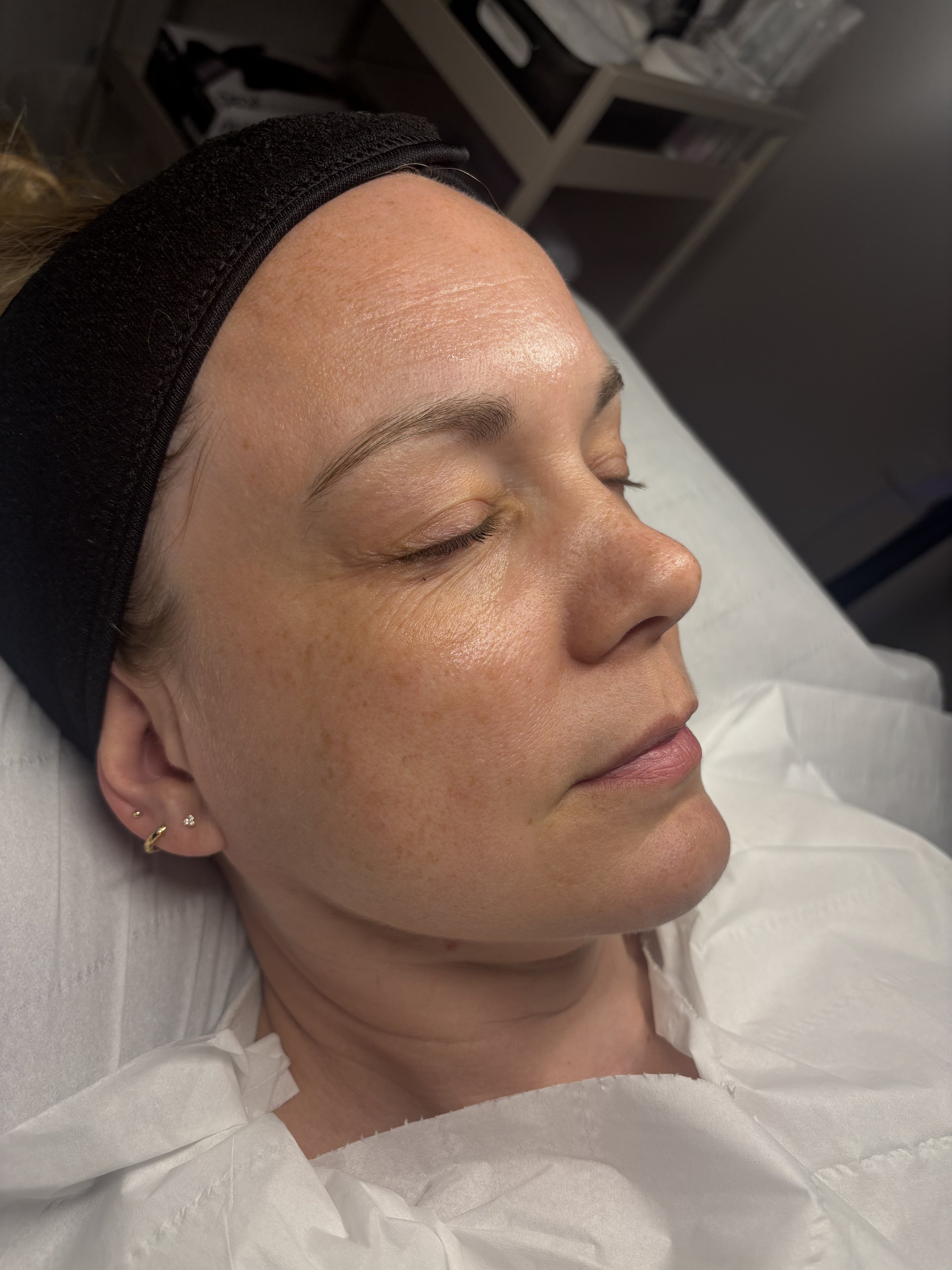 A woman with short, light brown hair and earrings, lying down with her eyes closed, wearing a black headband and a white medical gown.