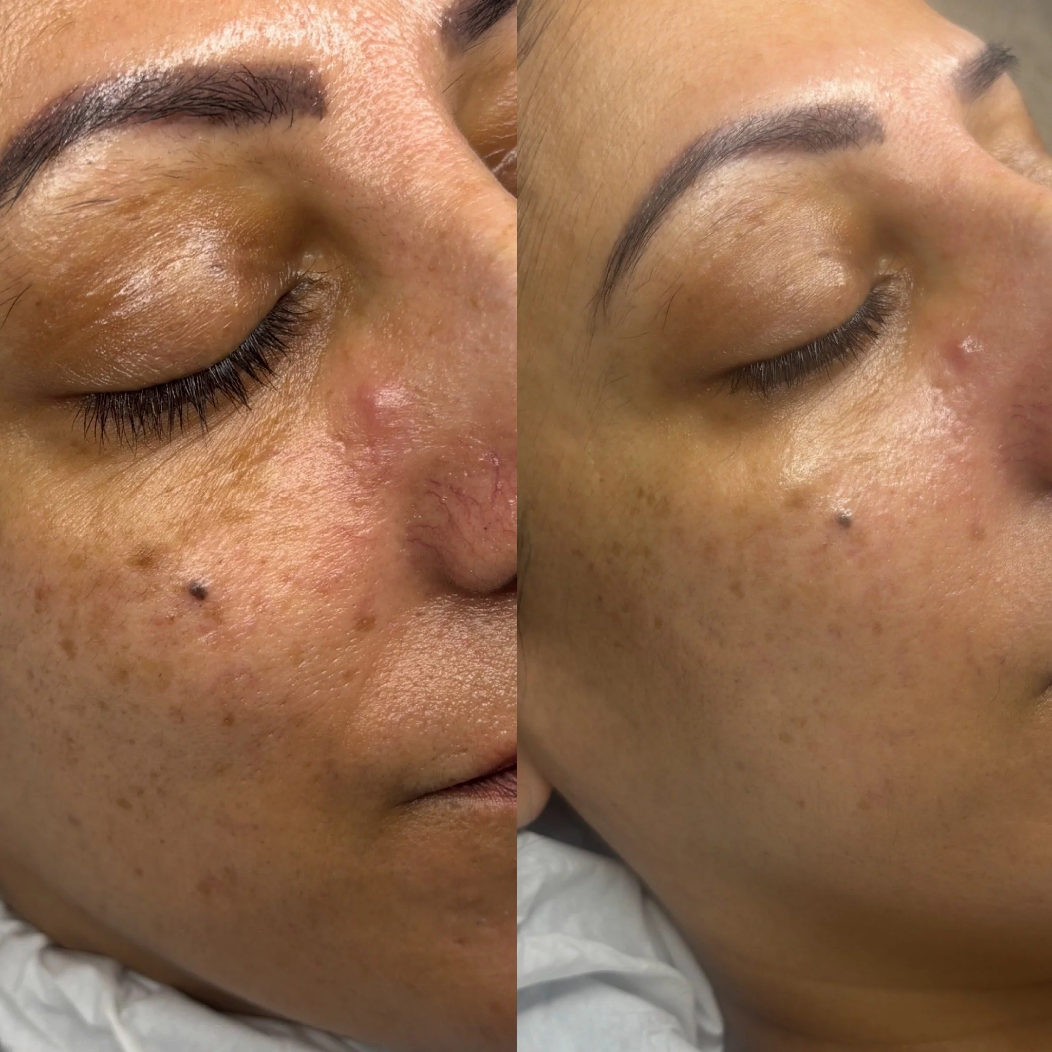 Close-up of a person's face showing a before and after comparison of skin with and without blemishes, indicating a skincare treatment or cosmetic improvement.