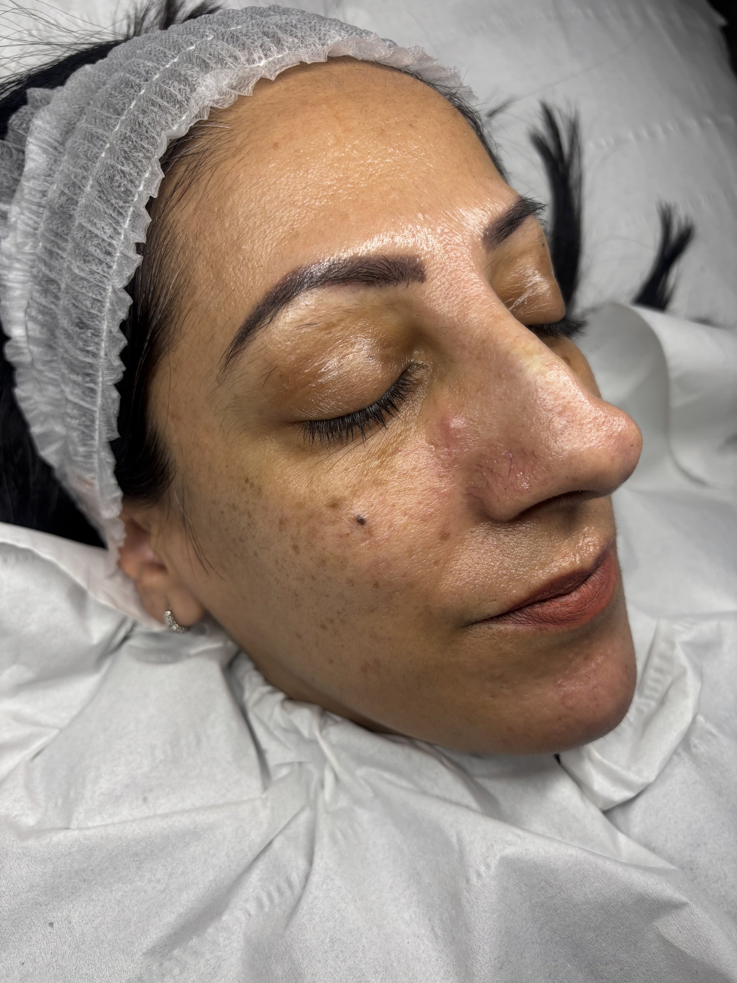 Close-up of a woman's face with dark eyebrow makeup, eyes closed, lying down in a medical setting with a white head covering and gown.