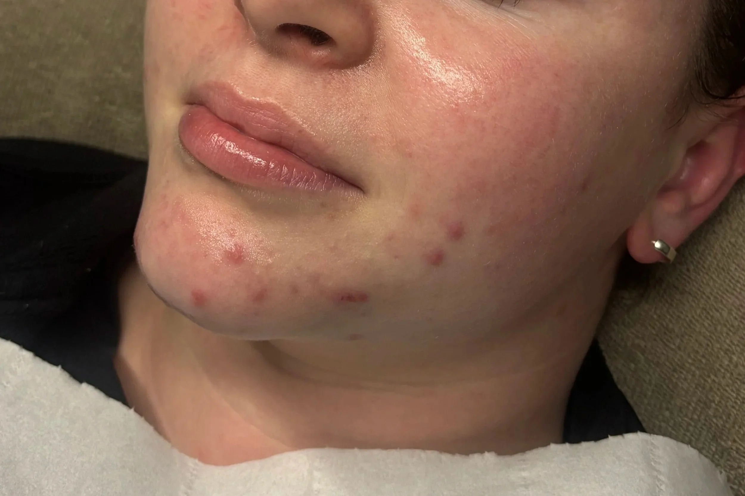 Close-up of a person's face showing redness, pimples, and blemishes on the cheek and chin area.