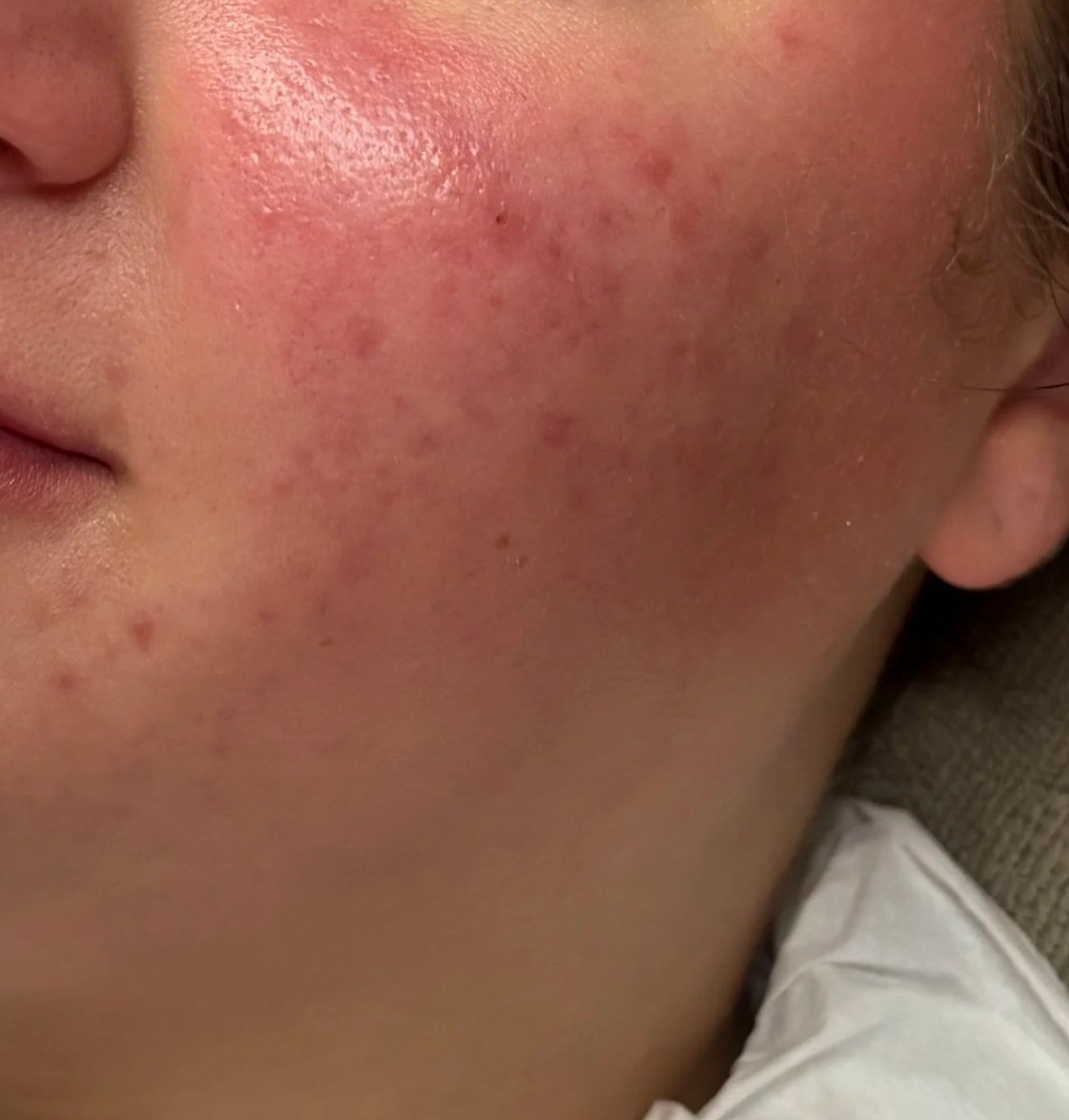 Close-up of a person's cheek showing red acne scars and skin irritation.