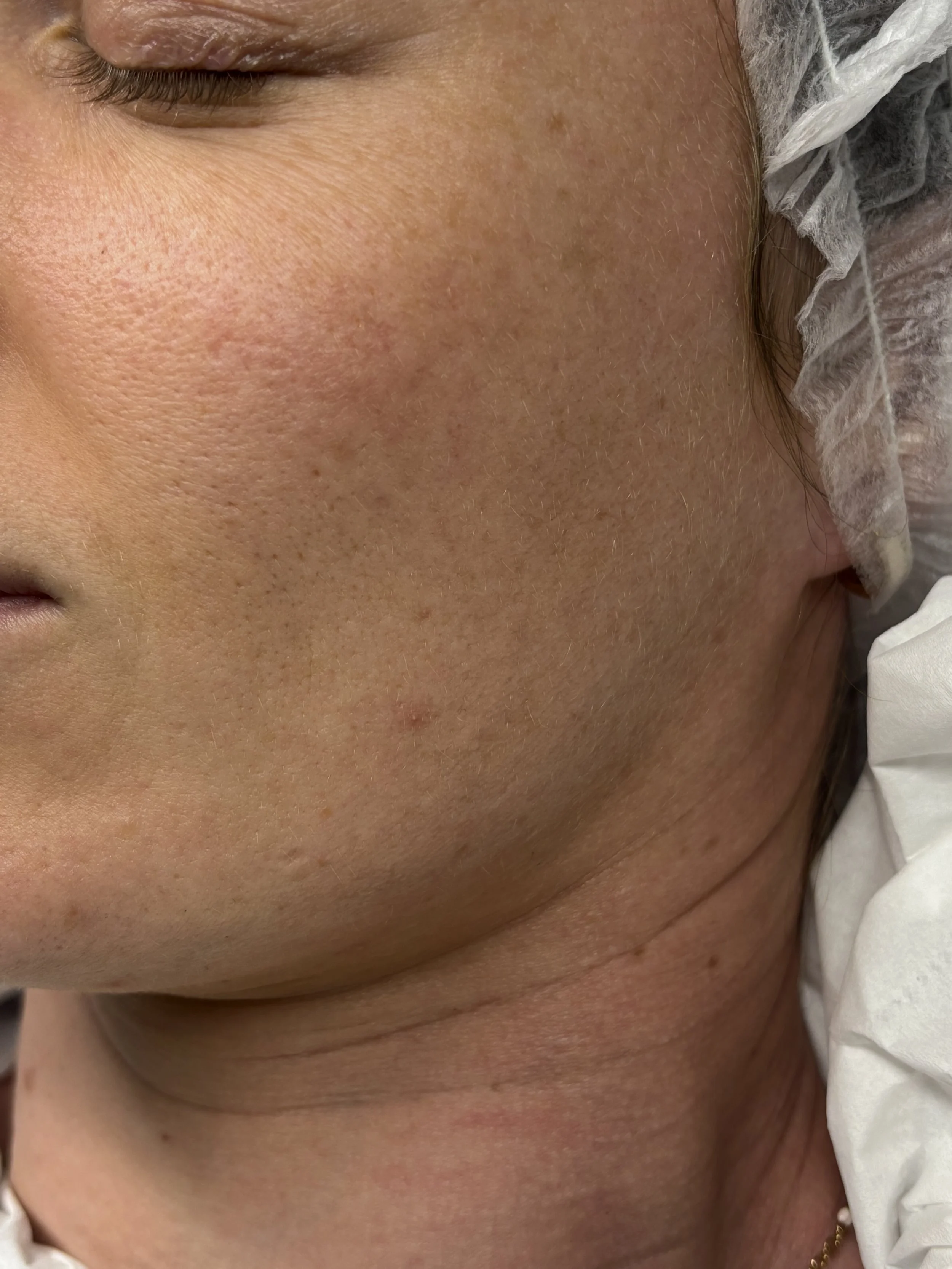 Close-up of a person's cheek and jawline with visible skin texture and pores, partially covered by a white medical or cosmetic cloth around the face.
