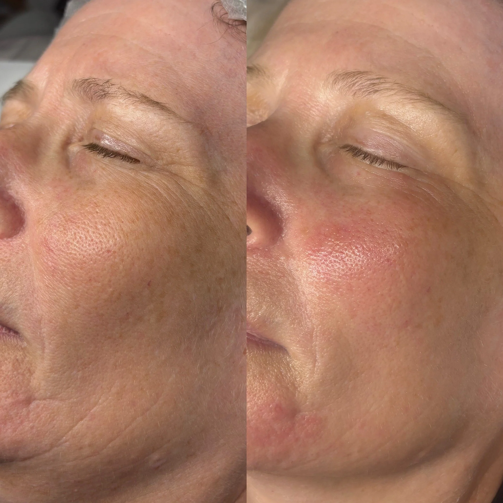 Close-up of a person's forehead and closed eye, showing skin texture with minimal wrinkles and natural skin tone.