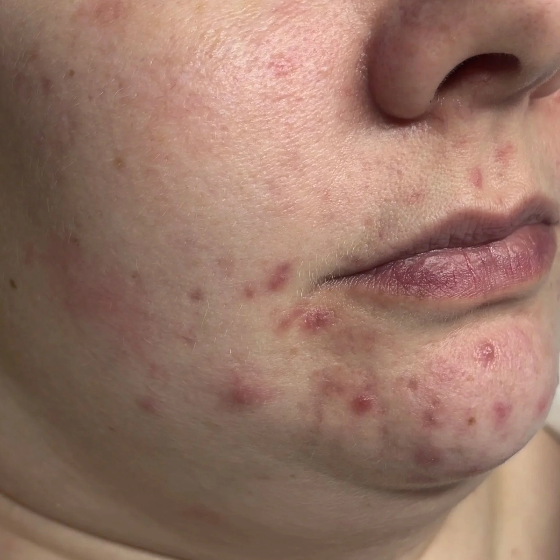 Close-up of a person's nose and surrounding skin, with some redness and small pimples.