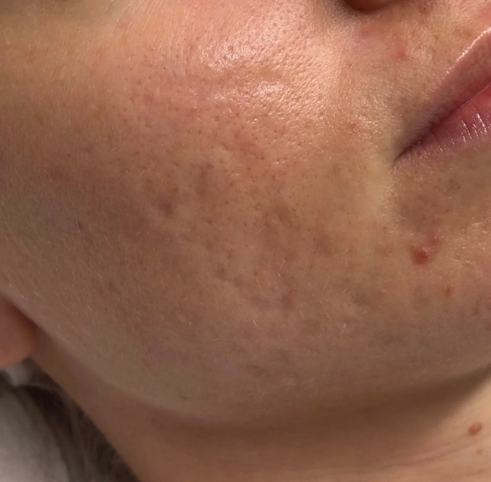 Close-up of a person's skin showing pores, small pimples, and hyperpigmentation on the cheek.