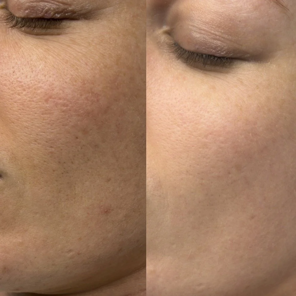 Side-by-side comparison photo of a person's cheek, showing improvement from acne or skin condition to clearer skin.
