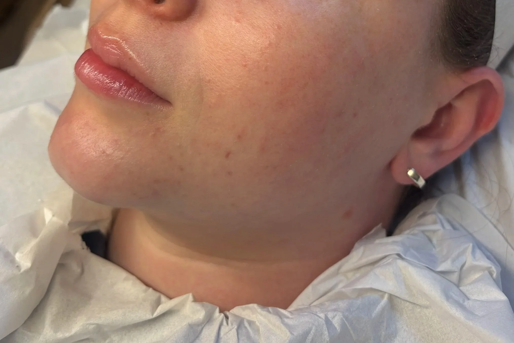 Close-up of a person's face showing lips, nose, cheek, and ear, with a background of white medical or paper material.