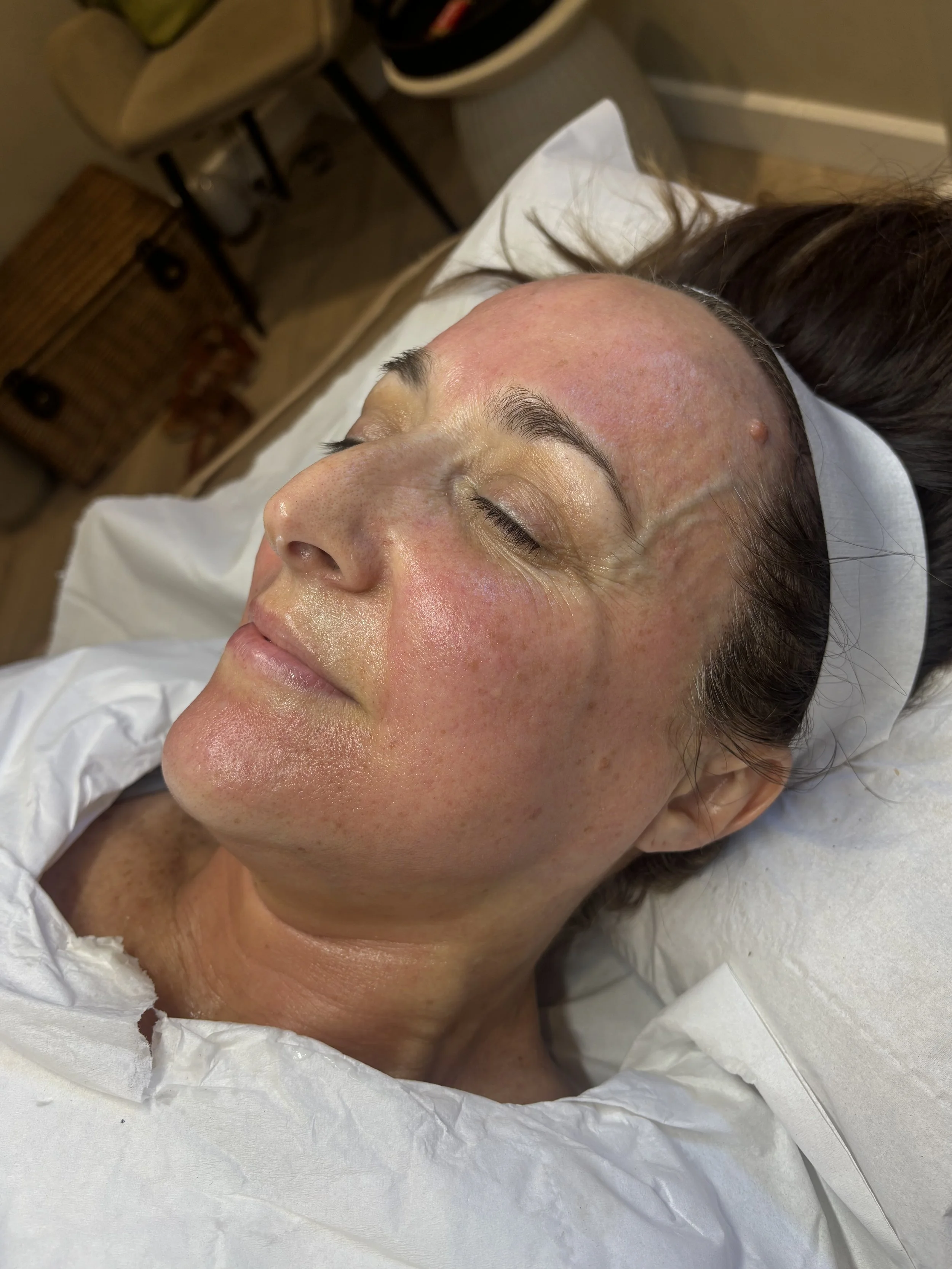 A woman with closed eyes lies on a medical bed, her face appears red and slightly swollen, with a small blister or pimple on her forehead. She is resting, possibly receiving a facial treatment or undergoing a skincare procedure.