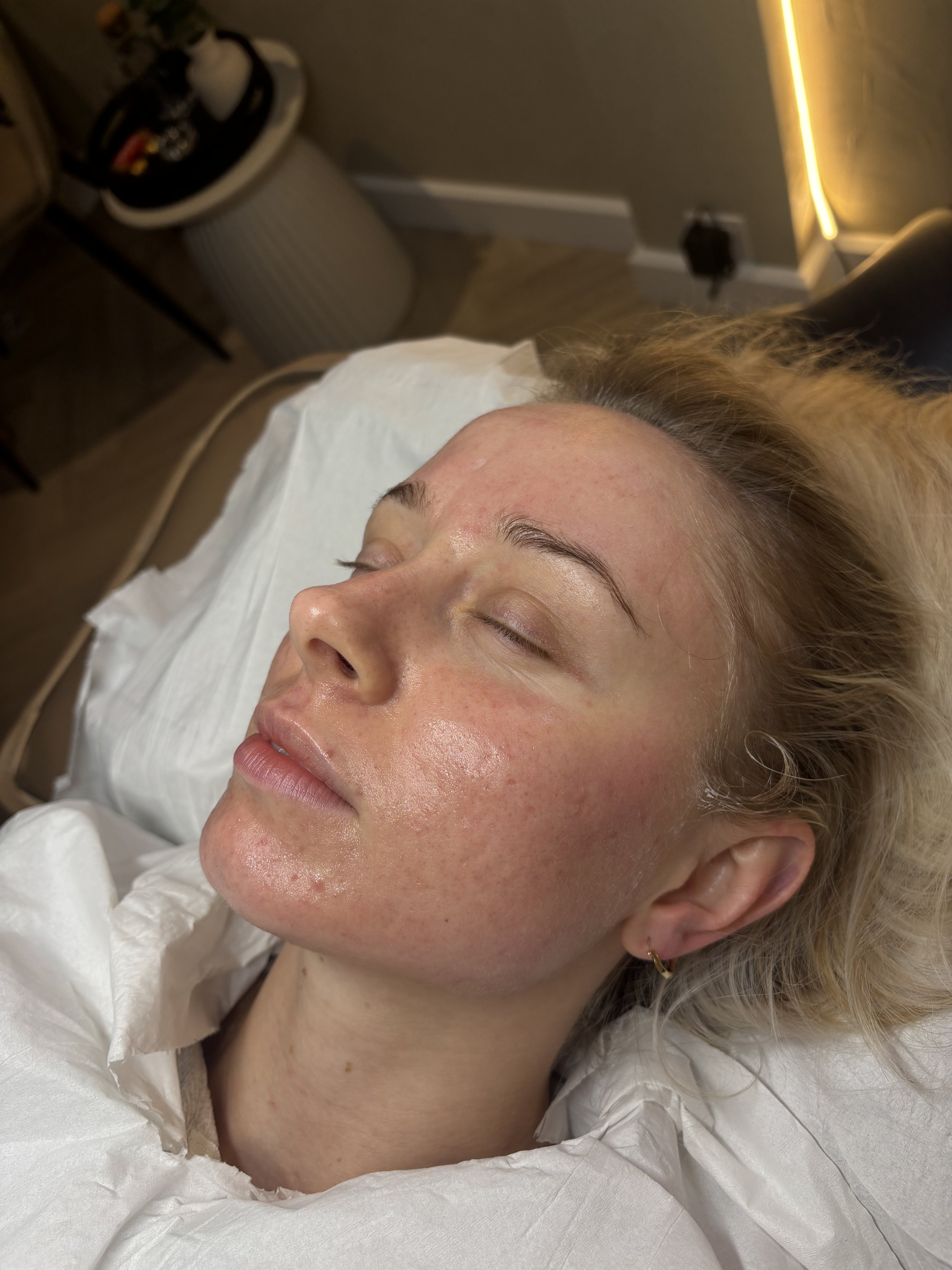 Close-up of a woman with fair skin and blonde hair lying down with eyes closed, in a medical setting. She wears a white gown and appears to be receiving a skincare or cosmetic treatment.