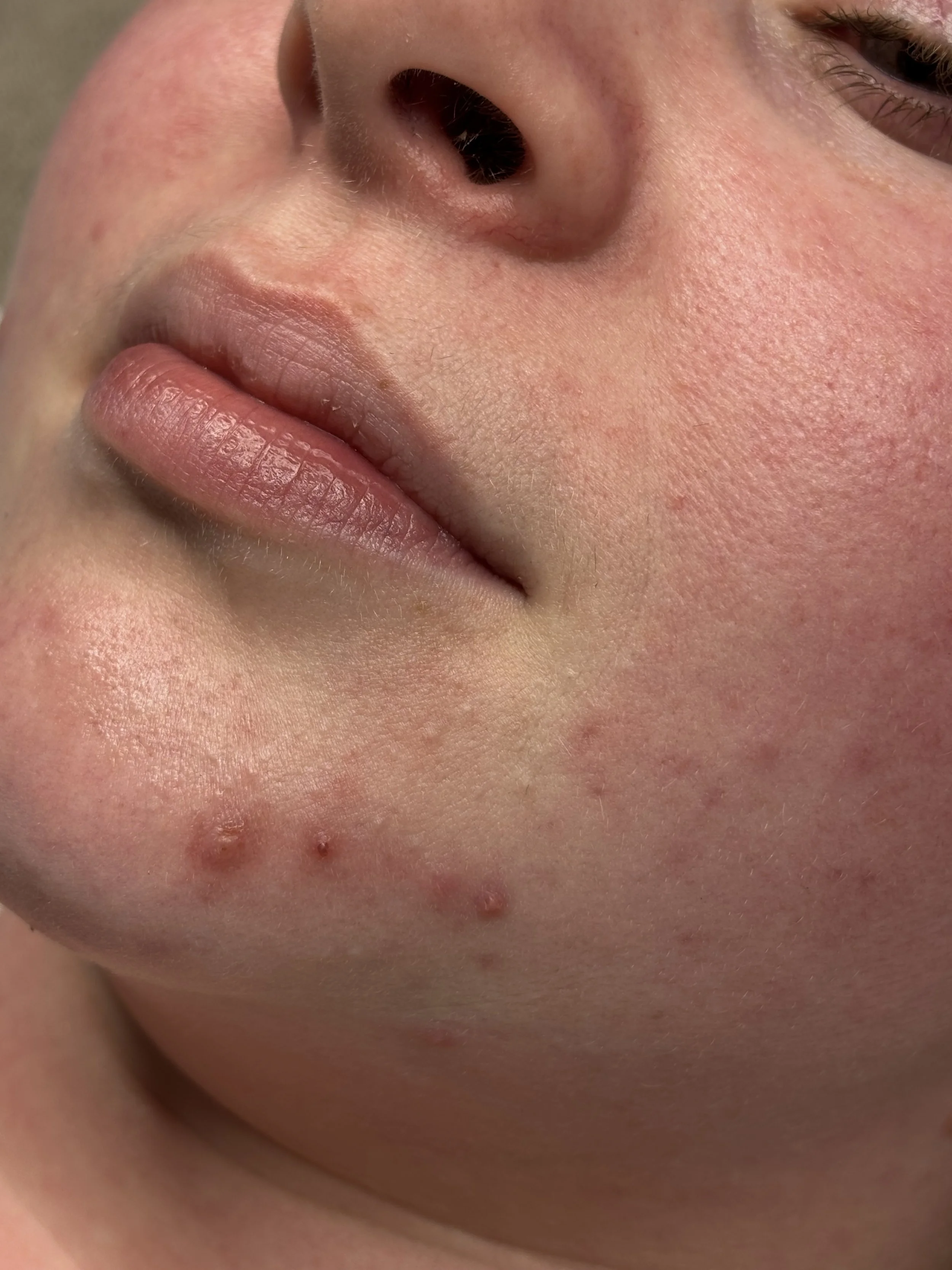 Close-up of a person's nose, lips, and chin with acne and skin imperfections.