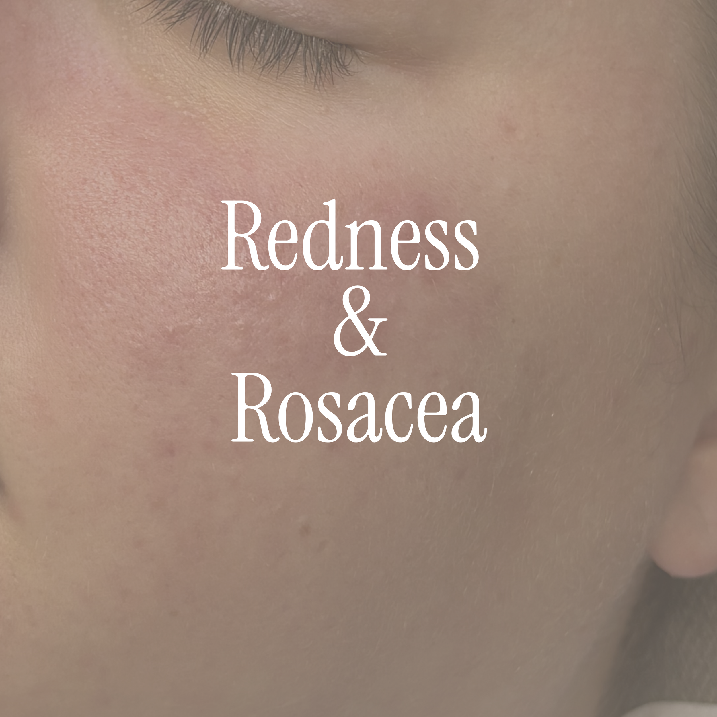 For redness, flushing, inflammation, sensitivity and skin that reacts easily.