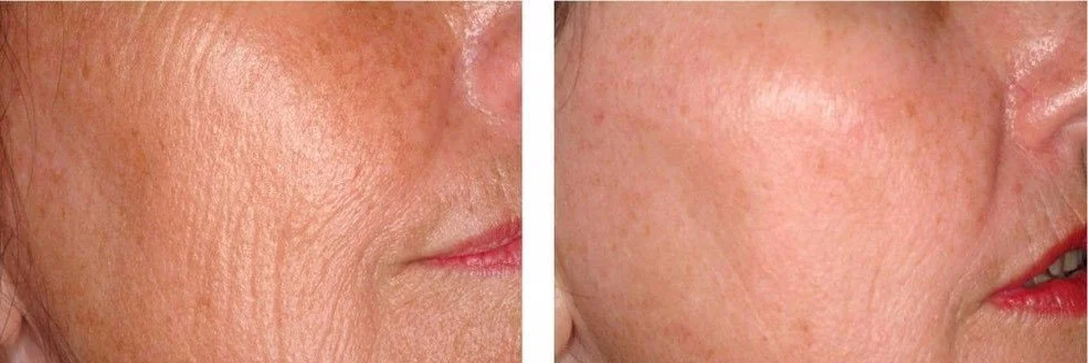 Side-by-side comparison of a person's skin showing before and after skincare treatment, with improved skin texture in the after image.