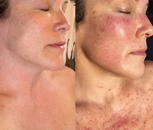 Side-by-side comparison of a woman's face before and after a skincare treatment, showing improvement in skin clarity and reduction of redness.