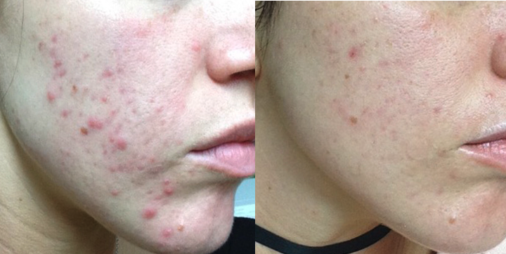Comparison of facial skin with acne and cleared skin showing reduced pimples and redness.