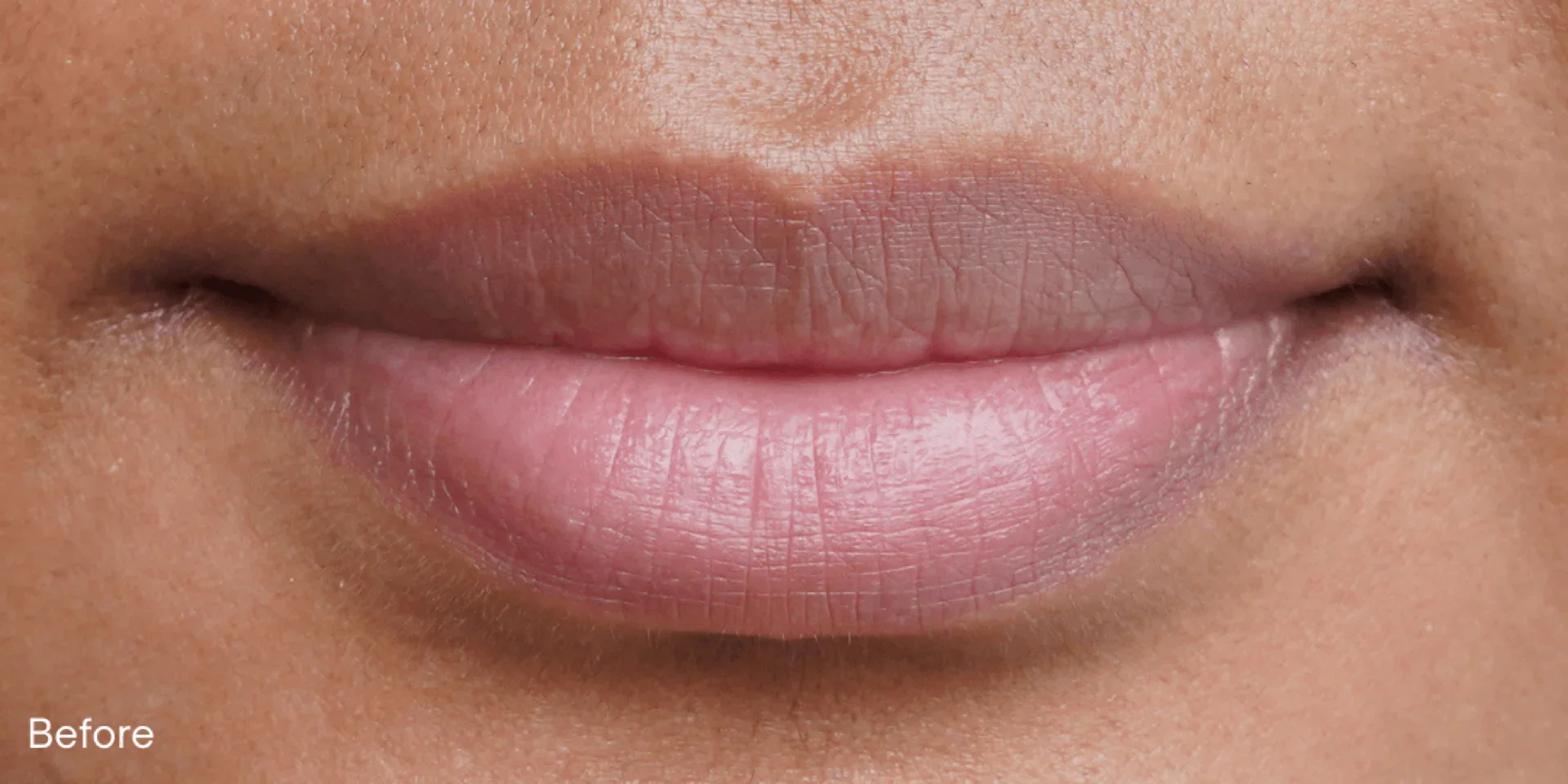 lipserum-ba1-before.webp