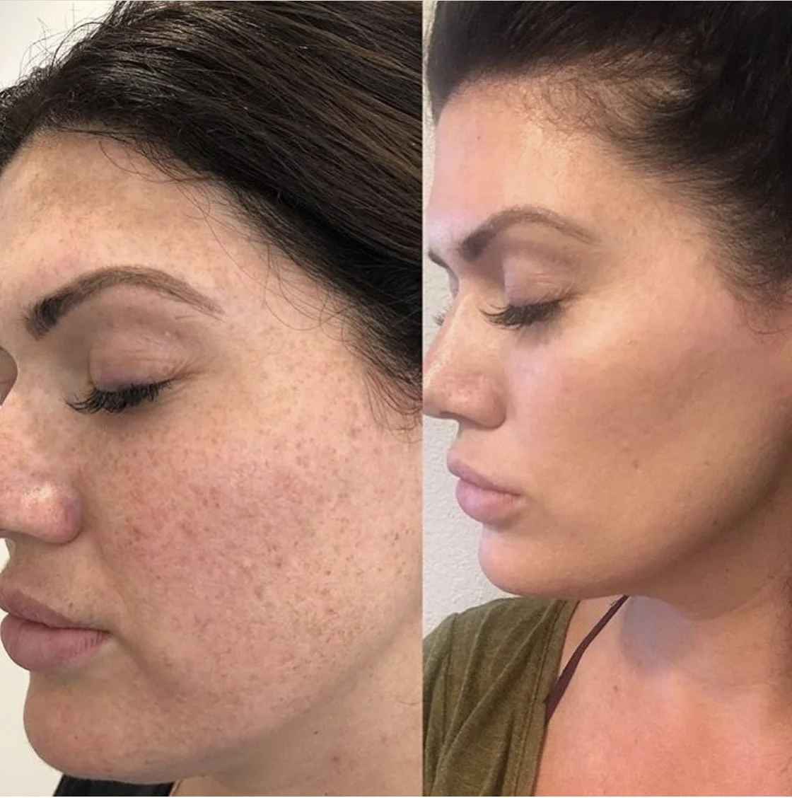 Before and after side-by-side close-up photos of a woman's face showing reduced freckles and clearer skin.