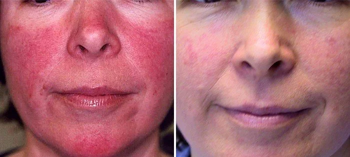 Close-up of a person's face before and after treatment showing reduced redness and clearer skin.