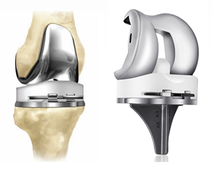 Severe Knee Osteoarthritis: Bypassing the 6-Month Wait for Robotic Replacement in Beijing