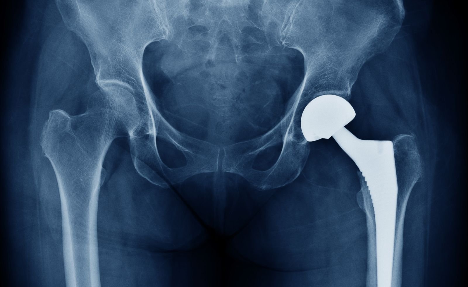 Hip Osteoarthritis &amp; Avascular Necrosis: Escaping Long Waitlists with High-Volume Surgery in Beijing