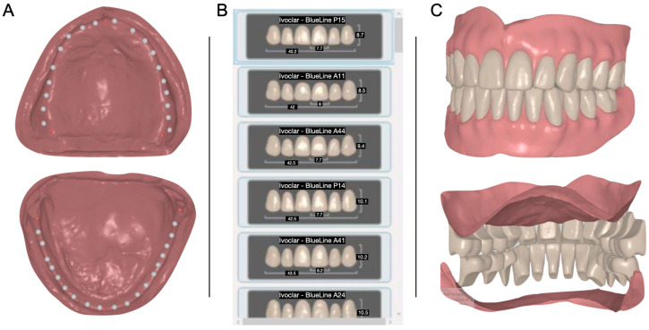 Full Mouth Rehabilitation After 15 Years of Worn Dentures