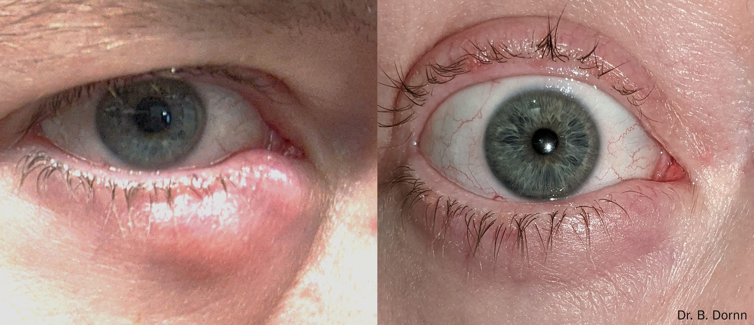 lumecca-forma-i-before-after-dr-b-dornn-preview-1.png