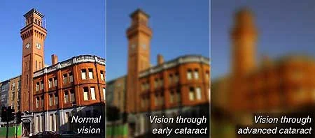 Side view of a historic red brick clock tower building compared in normal vision, early cataract, and advanced cataract.